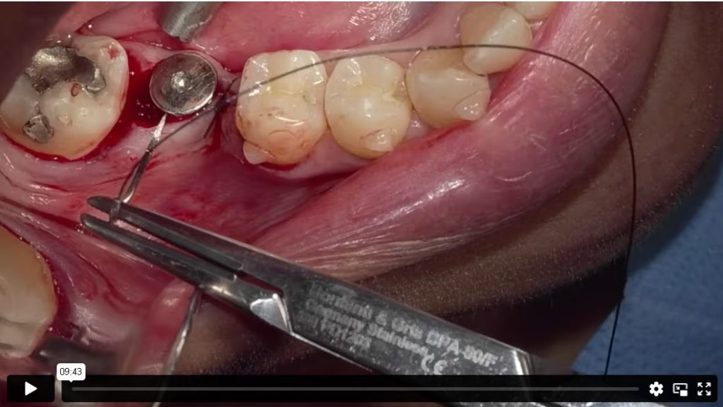 Implantology oxo footage_oxo 4k dental camera_surgicams usa